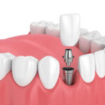Zubné implantáty sú pre tých, ktorí potrebujú tretie zuby